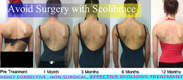 Vancouver Scoliosis  Treat Scoliosis Without Surgery